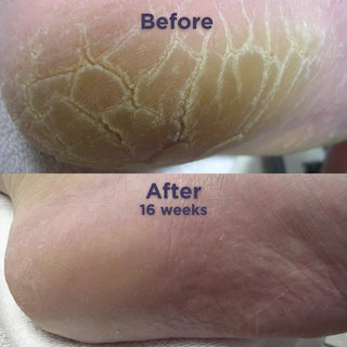 Footlogix Cracked Heel Formula Mousse, 125 ml Footlogix 