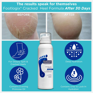 Footlogix Cracked Heel Formula Mousse, 125 ml Footlogix 