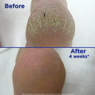 Footlogix Cracked Heel Formula Mousse, 125 ml Footlogix 