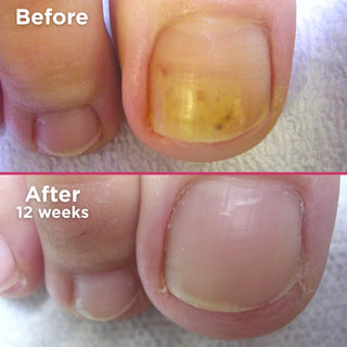 Footlogix Nail Tincture Spray, 50 ml Footlogix 