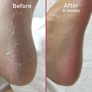 Footlogix Peeling Skin Formula Mousse, 125 ml Footlogix 