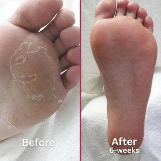 Footlogix Peeling Skin Formula Mousse, 125 ml Footlogix 