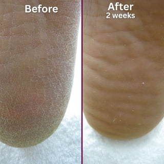 Footlogix Rough Skin Formula Mousse, 125 ml Footlogix 