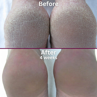 Footlogix Rough Skin Formula Mousse, 125 ml Footlogix 