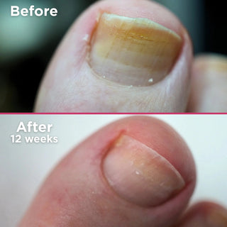 Footlogix Nail Tincture Spray, 50 ml Footlogix 