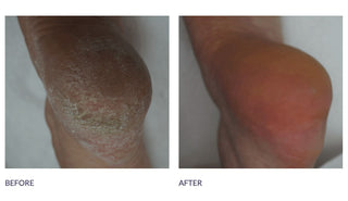 Footlogix Callus Softener, 3.78 L Footlogix 