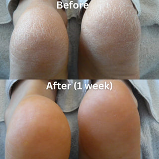 Footlogix Very Dry Skin Formula Mousse, 125 ml Footlogix 