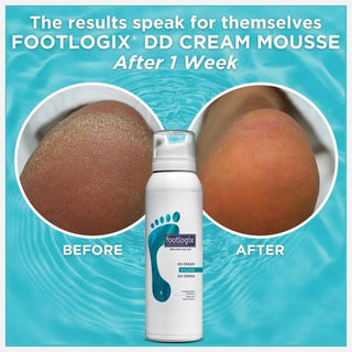 Footlogix DD Cream Mousse, 125 ml Dry to Cracked Skin Foam Footlogix 